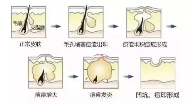 如何祛除痘坑？祛除痘坑最好的方法