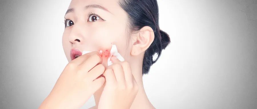 如何預(yù)防粉刺的發(fā)生和痤瘡的形成？