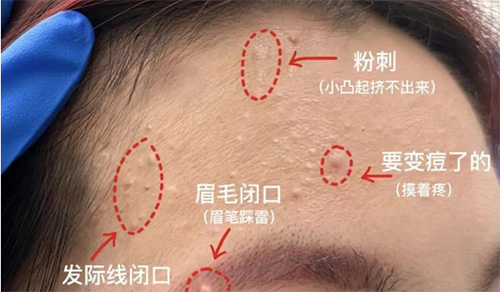 臉上經(jīng)常長閉口粉刺的原因有哪些？