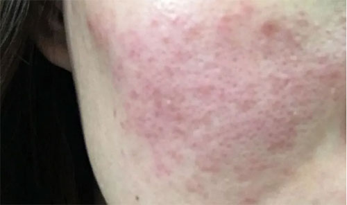 皮膚泛紅癢是什么原因？皮膚紅癢怎么回事？