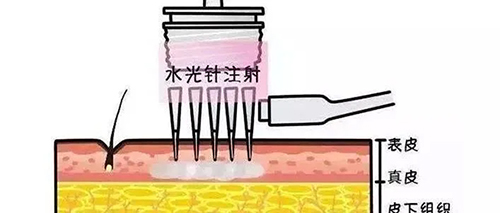 水光針的類型有哪幾種？