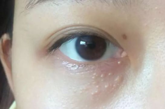 為什么眼部容易長脂肪粒？